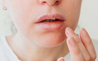 Epavir lágy kapszulával herpes simplex vírus ellen