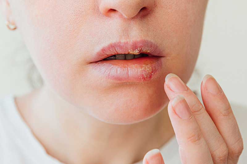 Epavir, Herpes Simplex vírus